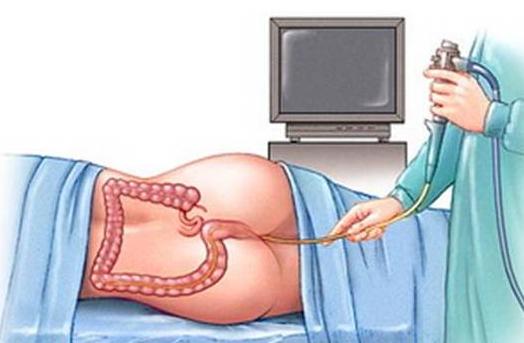 肠癌造口回纳后容易引起复发吗,肠癌术后有回肠造口怎么饮食