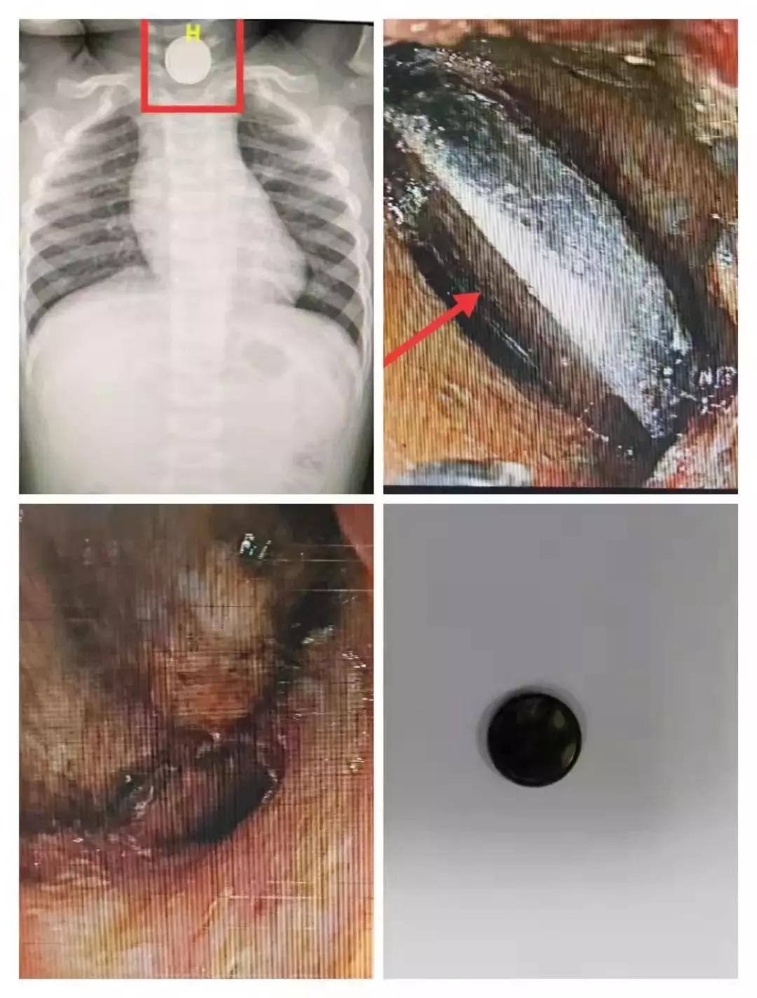 喉管长期被胃酸腐蚀会怎么样,小孩喉管被腐蚀