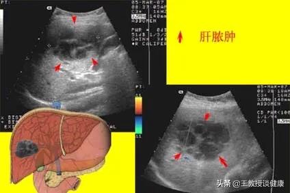 脓肿为什么会有硬结,肝脓肿和糖尿病的关系
