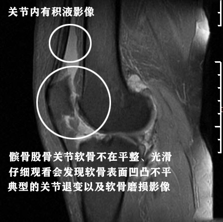 膝关节核磁共振报告单上怎么看,膝关节核磁正常报告单