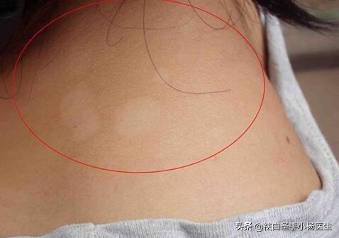 身上长白斑是白癜风吗如何确诊,小孩身上有白斑是白癜风还是汗斑