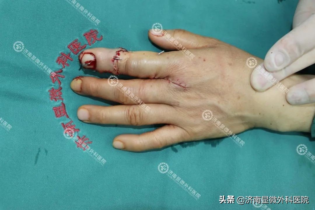 日本手指缺失修复,多年前断手指修复