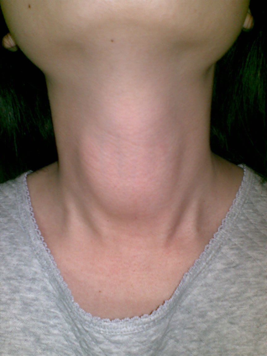 鱼鳞病是基因突变还是伴性遗传,板层型鱼鳞病可怕吗