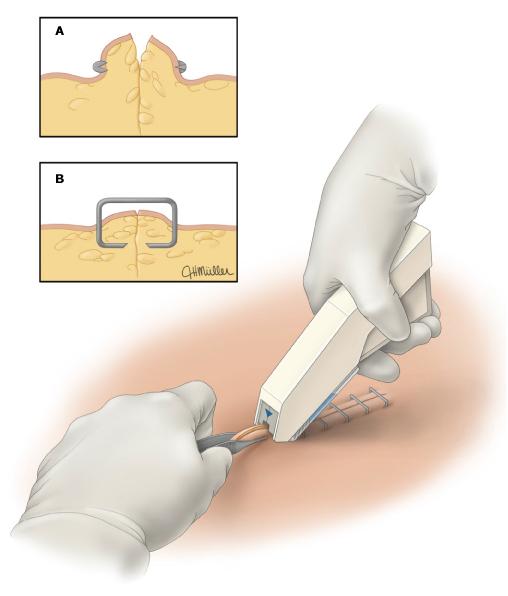 手术刀口上有订书钉怎么回事,手术伤口为什么要用订书针缝线