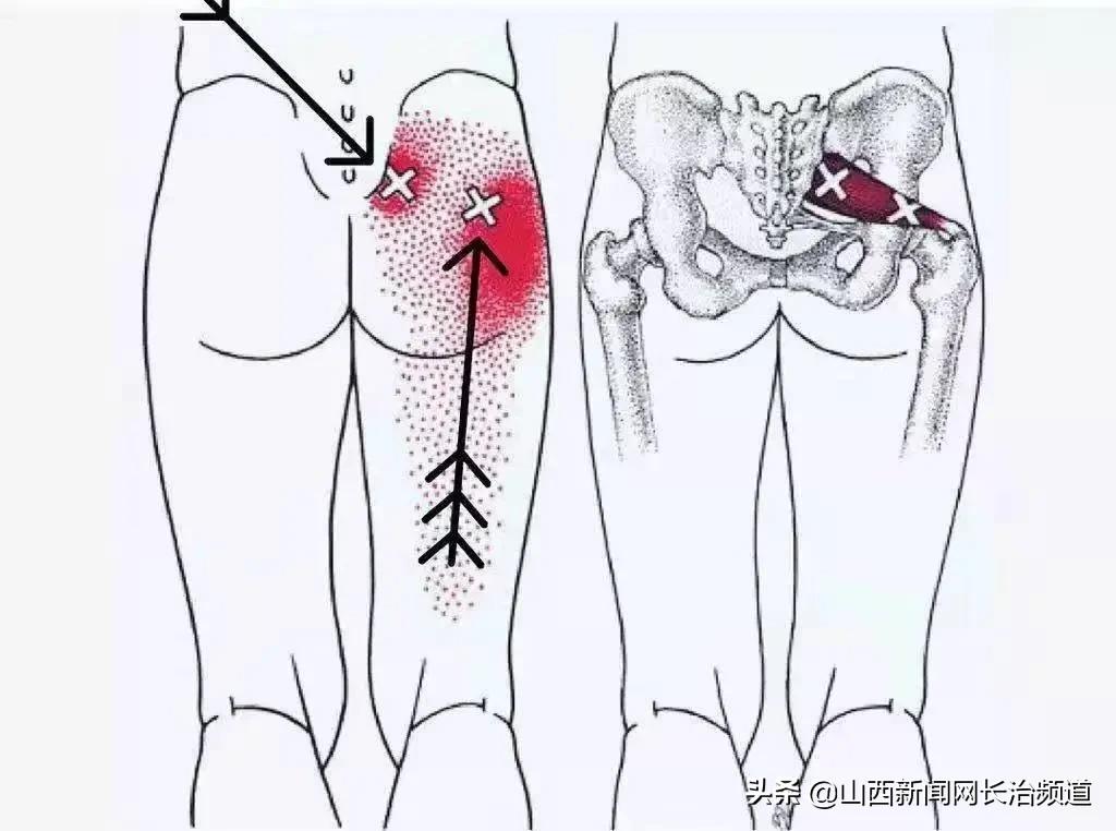 产后梨状肌疼痛怎么治疗,产后一侧屁股连着腿疼
