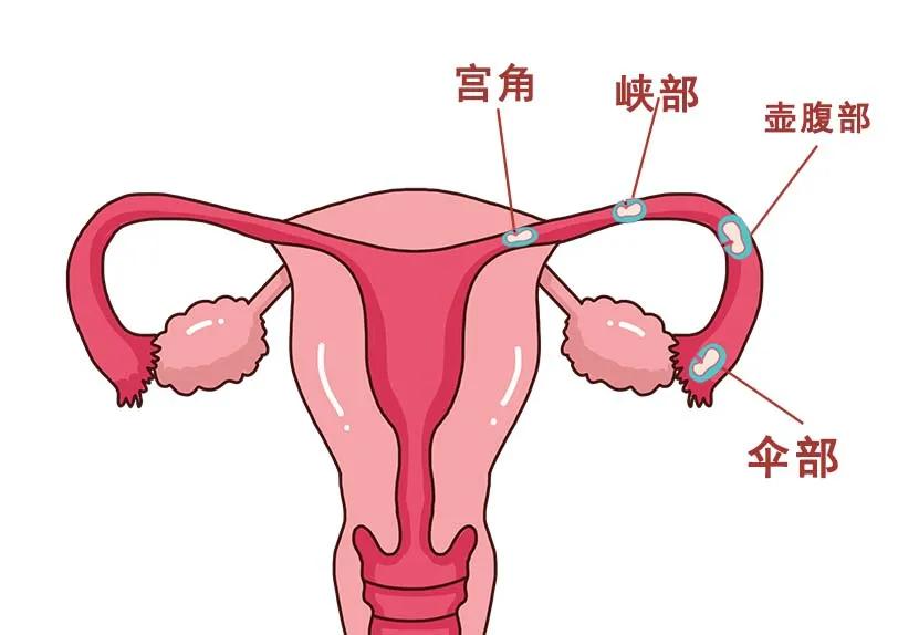一个输卵管怀孕还会出现宫外孕吗,一个输卵管还会出现宫外孕吗