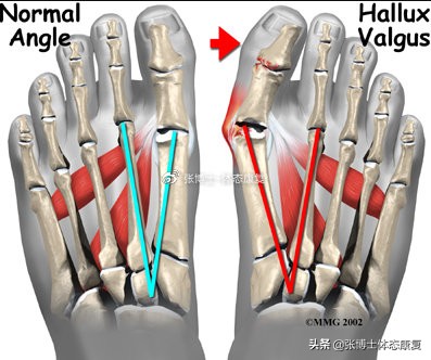 「功能训练」人体额状面稳定性与侧向子系统的关系