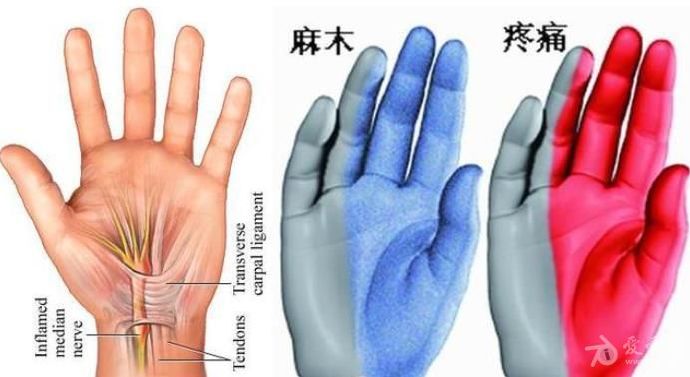 左手手指酸麻胀痛是什么病的前兆,手掌和手指酸麻疼痛是怎么回事