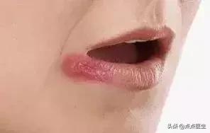 冬季嘴巴总是上火起泡？一招教你快速治愈