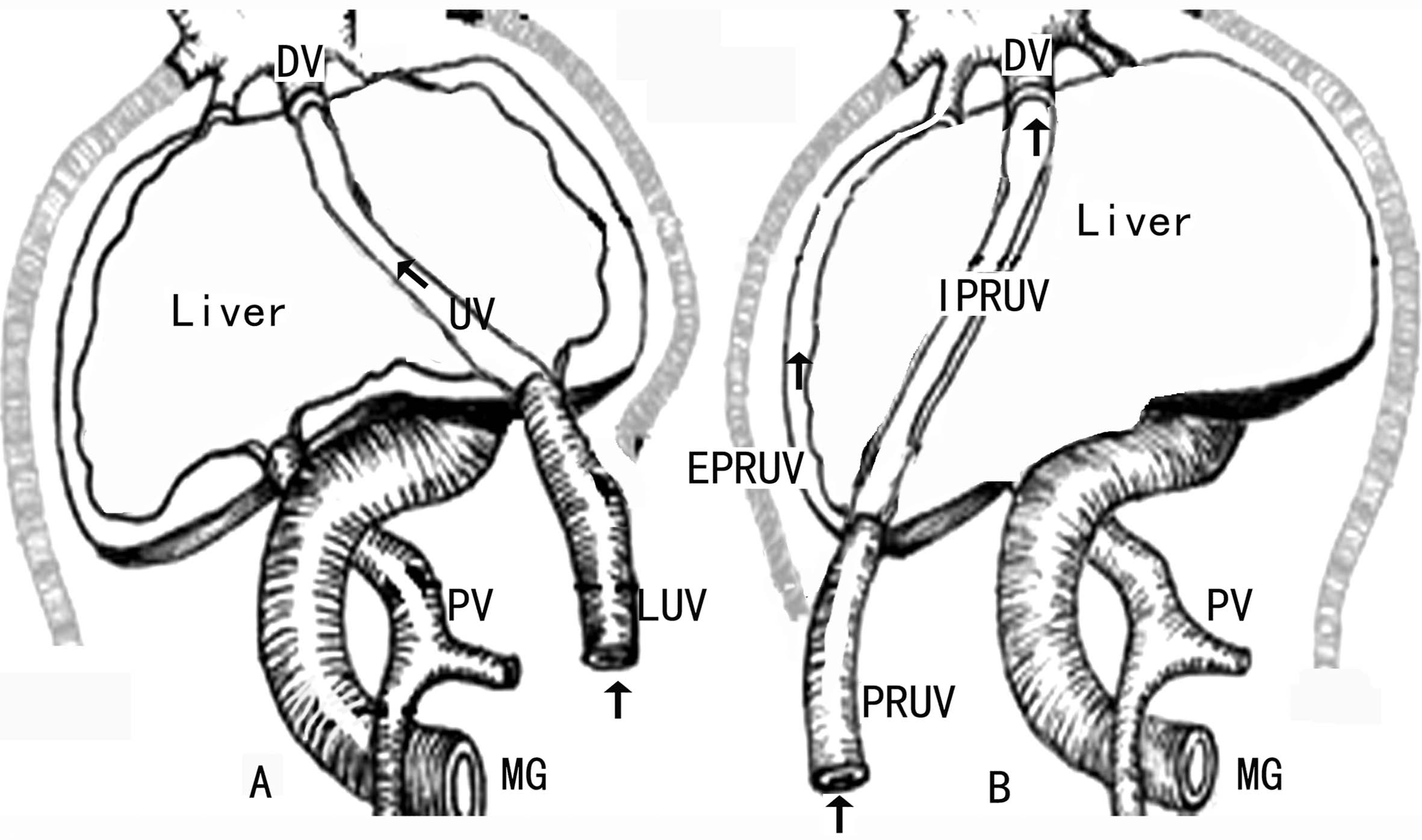 做高清彩超能看出脐带扭转吗,脐带超声异常