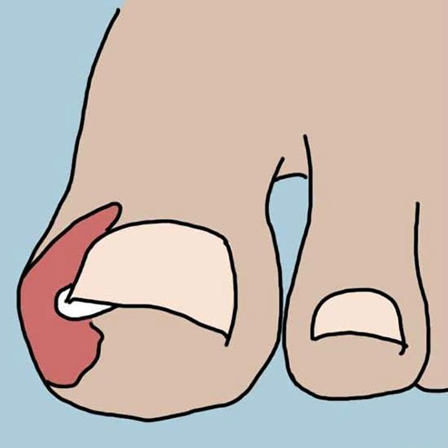 甲沟炎怎么办教你一招解决,甲沟炎怎么办用什么抗生素