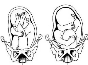 臀位想顺产怎么办,头臀位双胞胎顺产