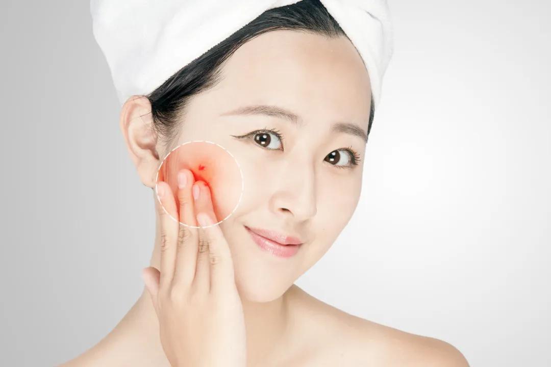 痘痘总是治不好怎么回事,痘痘怎么一直消不掉