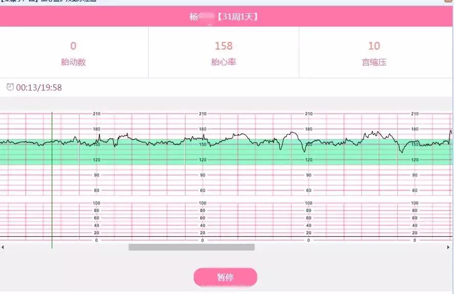 脐带绕颈两周不用怕教你应对办法,脐带绕颈3周怎么办危险吗
