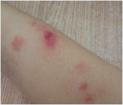 23岁女孩得了银屑病怎么办,学生得银屑病怎么办