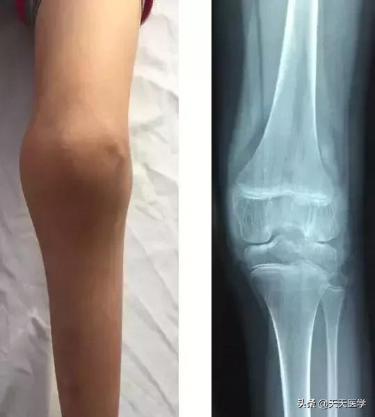 血友病的症状是什么,血友病的发病特点是