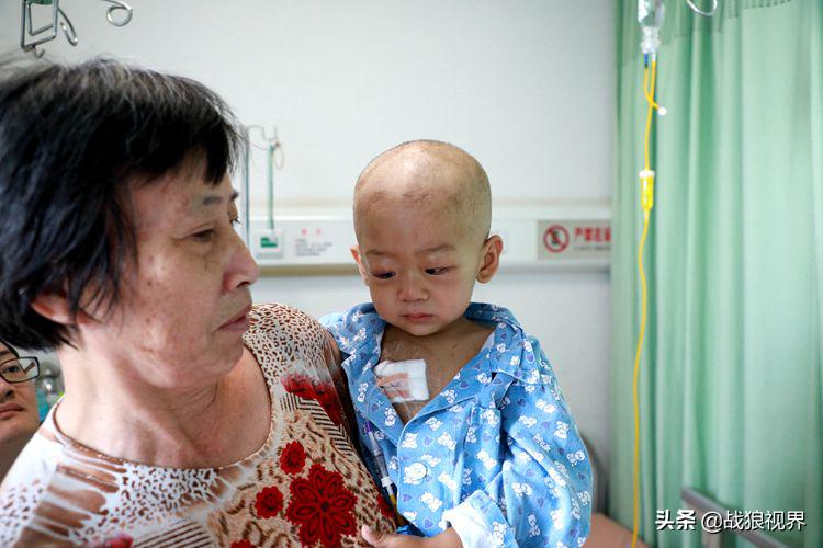 小孩摔一跤后引起眼袋淤青,2岁多男宝眼袋浮肿有点发紫