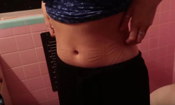 束腰导致内脏下垂漏尿,子宫脱落内脏下垂