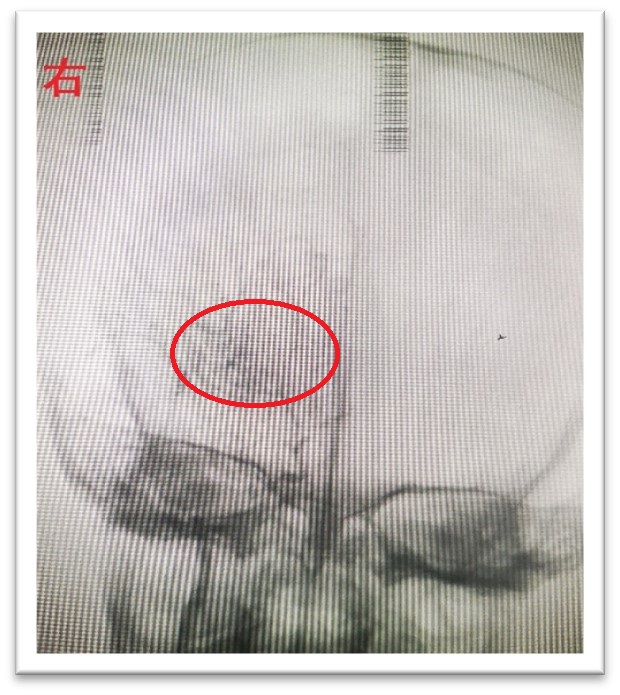 儿童突发左下肢无力,儿童下肢突然无法动弹