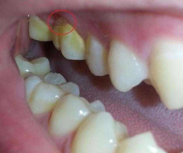 牙结石不洗牙用什么方法清除,牙结石有没有好的方法去除