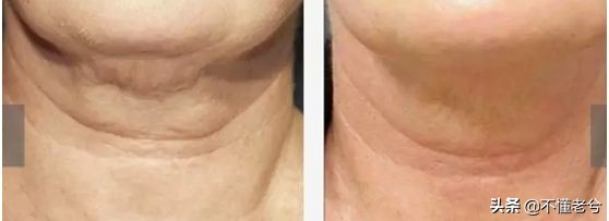 做提拉紧致的护肤有副作用吗,紧致提拉做美容有效吗