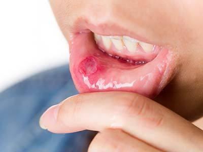 口腔溃疡怎么预防怎么治疗呢,口腔溃疡怎么办教你一招根除