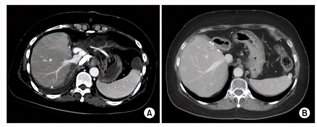 肝移植成功事例,中医治疗结肠癌肝转移的存活率