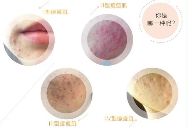 如何正确祛痘养好皮肤,战痘多年没有效如何正确祛痘