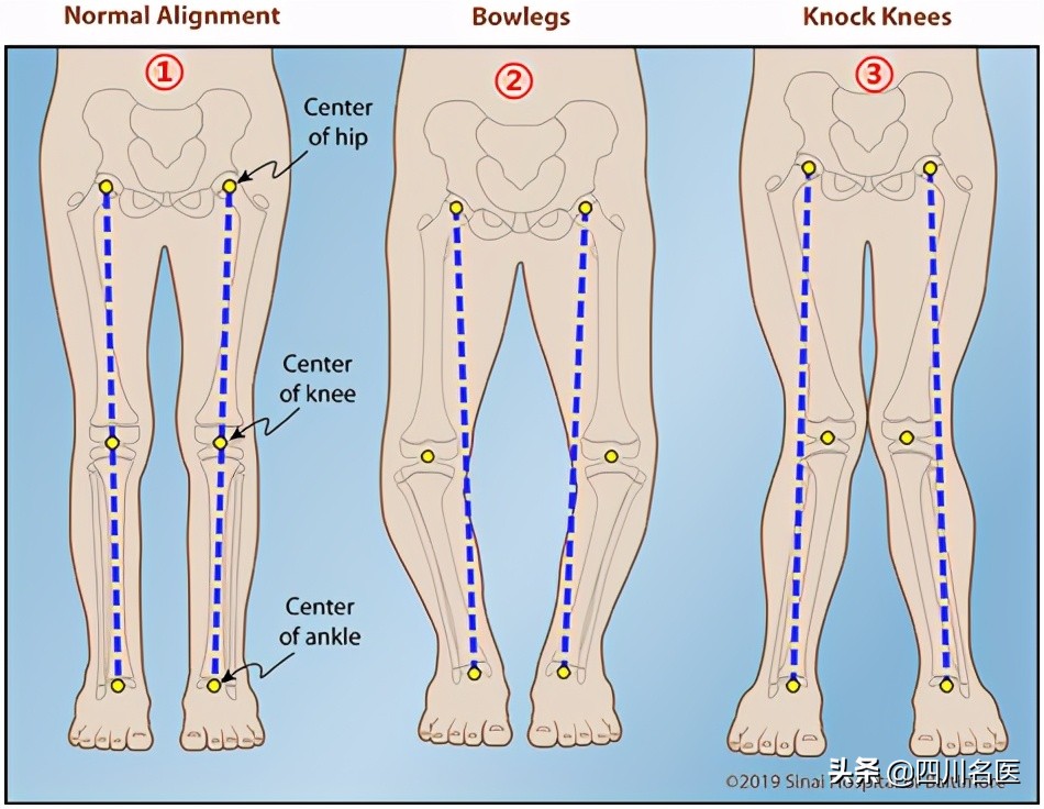怎么判断腿是骨头弯还是肌肉弯,腿型矫正变直的方法骨科