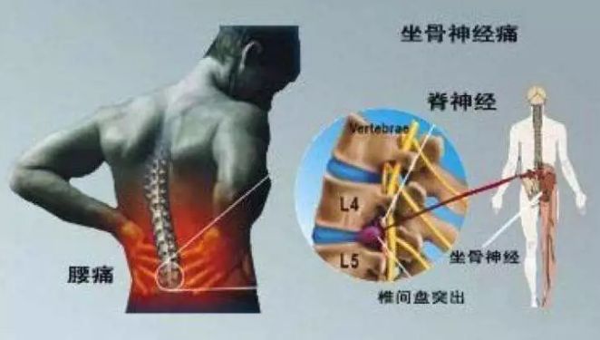 坐骨神经痛锻炼体操,坐骨神经怕站还是怕坐