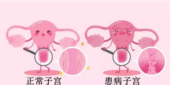 绝经一年多再来月经一定是癌症吗,绝经后有水样分泌物无味是癌症吗