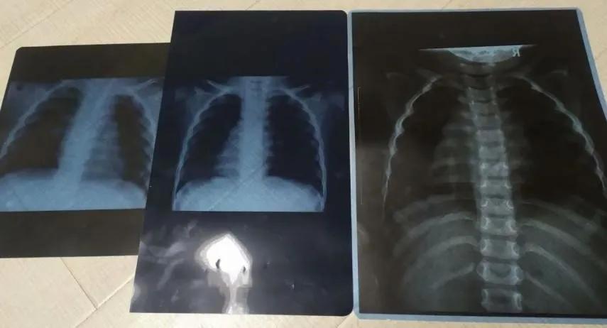 坚持锻炼可以缓解过敏性鼻炎吗,坚持锻炼可以治疗鼻炎吗