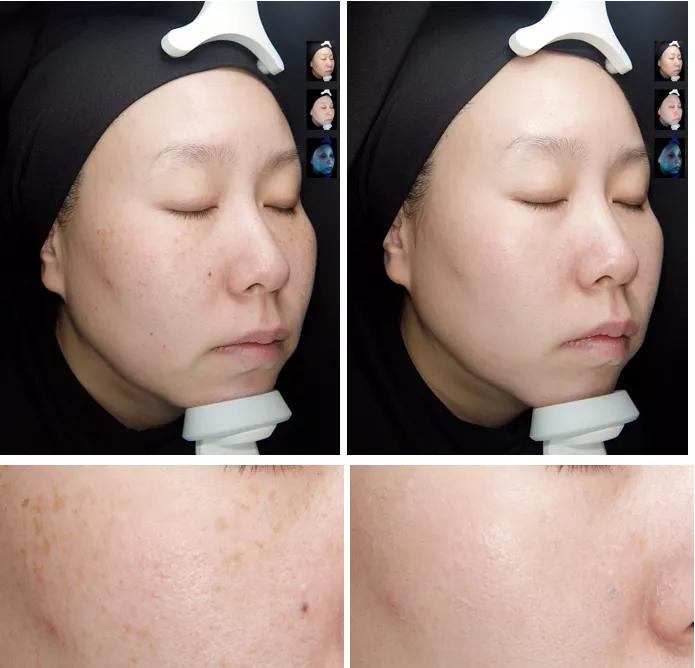 瞬间让脸变白的神器,让斑快速消失