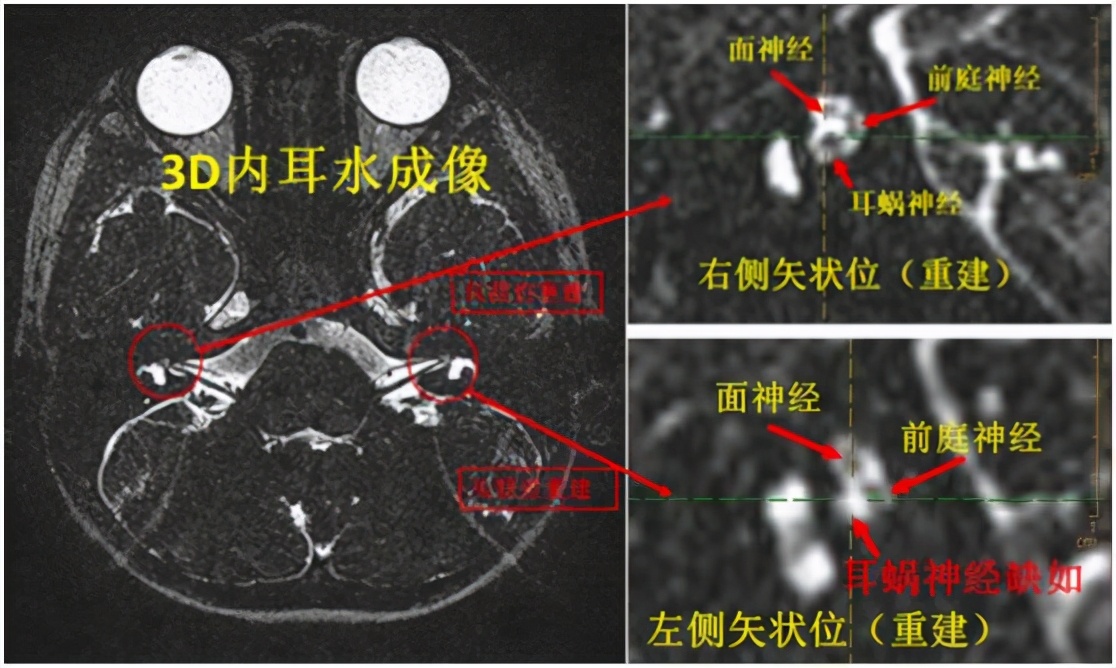 爱耳日听力突然下降怎么办,孩子听力下降是耳蜗出现问题吗
