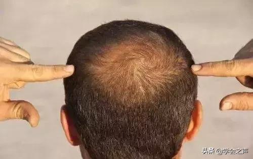 亲测有效的防脱发小技巧,脱发严重这个防脱发妙招很好用