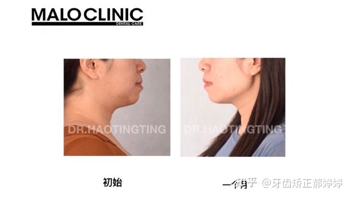 上海成人牙齿矫正失败案例,上海牙齿矫正郝婷婷医生