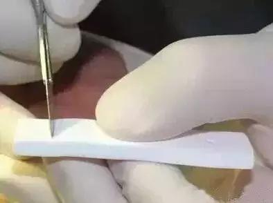 鼻整形后出现肿胀,鼻子整形后假体外露是手术失败吗