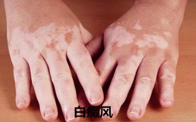 白癜风牛皮癣,牛皮癣白癜风的问题