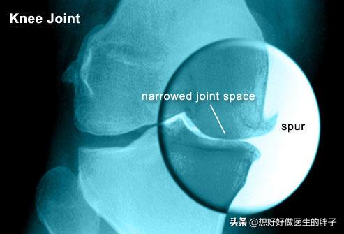 膝关节骨刺正确治疗方法,膝关节骨刺怎么缓解症状