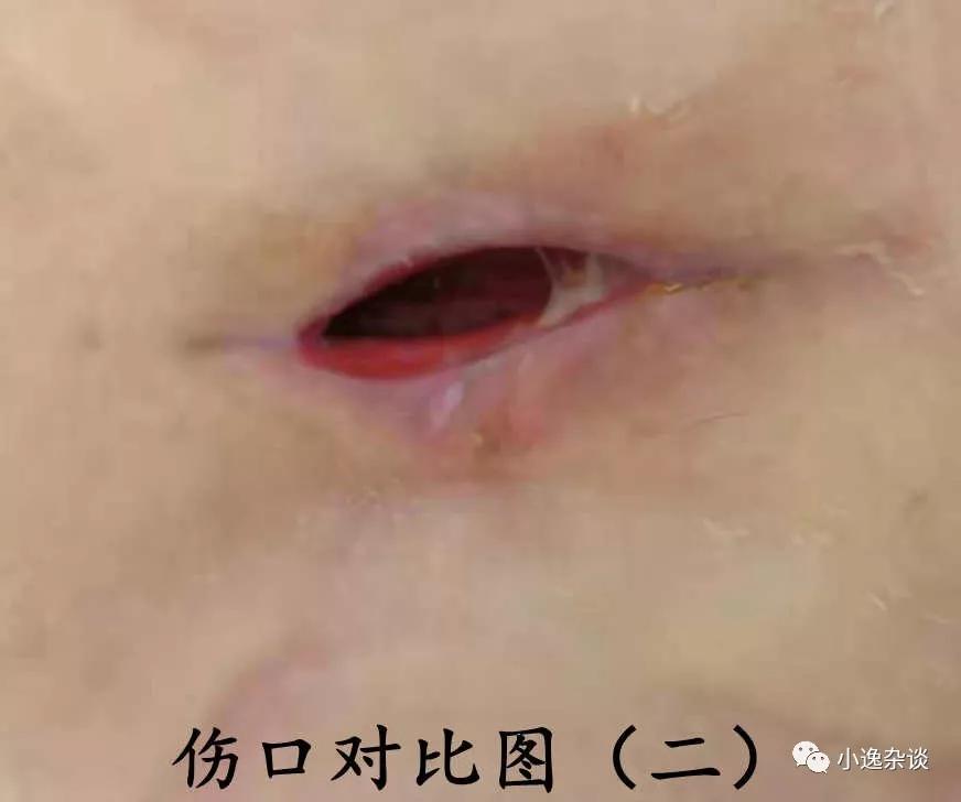 皮肌炎回忆录（十）