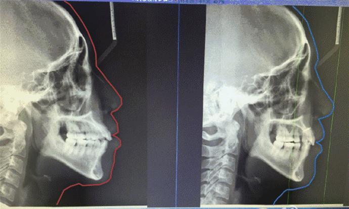 八岁孩子牙齿不齐用什么矫正,十岁小孩牙齿不齐需要矫正吗