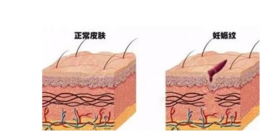 祛妊娠纹的产品亲测,明星用的祛妊娠纹产品
