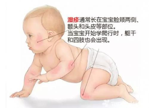 急性湿疹和亚急性湿疹,湿疹会变成干性湿疹吗