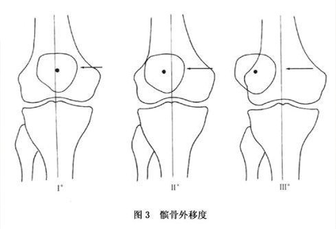 髌骨脱位复发性与习惯性区别,儿童髌骨脱位原因是什么