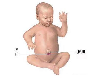 新生儿肚脐眼出血如何消毒,新生儿肚脐眼碘伏消毒出血了