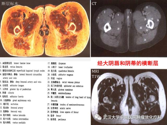 女性盆腔解剖与断层影像