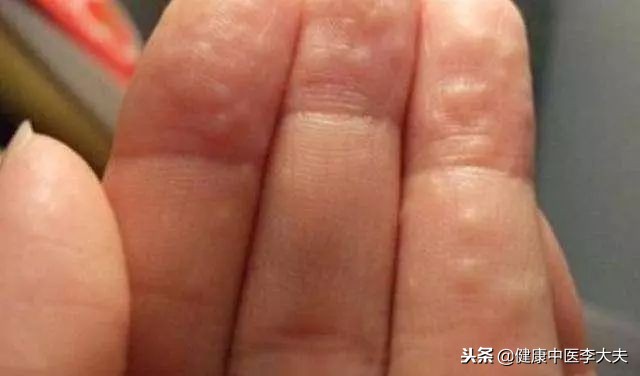 手脚一抓就长许多小水泡中医辨证,小孩手脚身上长水泡还痒怎么办