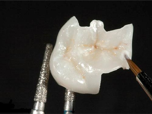 严重的蛀牙怎么修复,轻微的蛀牙修复全过程