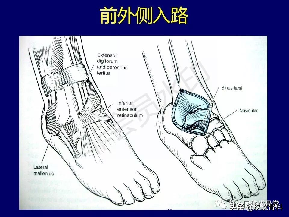 距骨骨折后遗症,距骨骨折怎么办