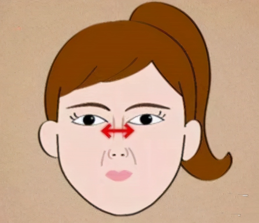 开眼角过大图片,开眼角过大修复效果图